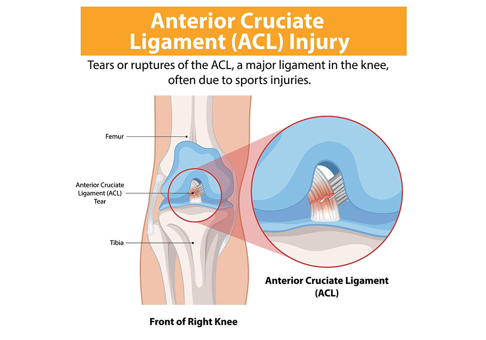 What Is ACL Reconstruction?