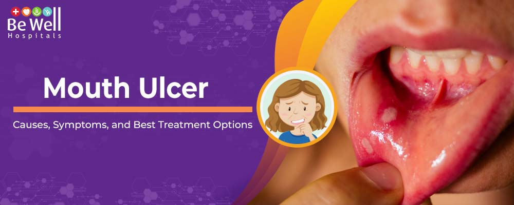 Mouth Ulcer: Causes, Symptoms, and Best Treatment Options image